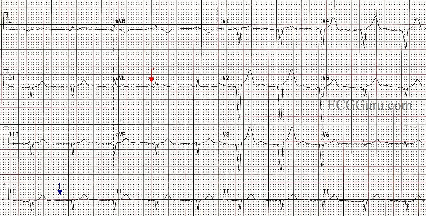 Paced Rhythm Following AV Node Ablation ECG Guru Instructor Resources